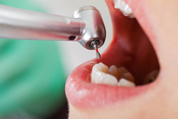 Best Knocked-Out Tooth (Avulsed Tooth) Treatment in South Elgin, IL